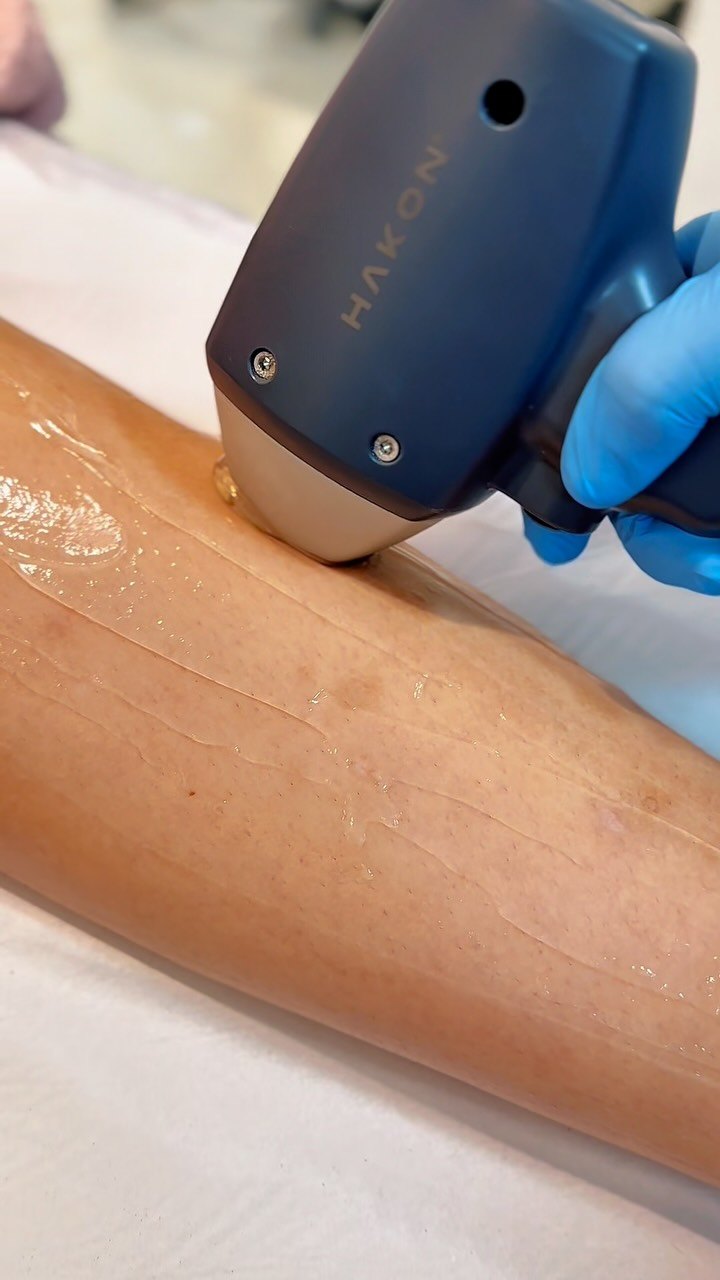 Liber Hair & Esthetic - laser